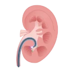 Ureteroscopio digital flexible de un solo uso CoralView serie U - Imagen 2